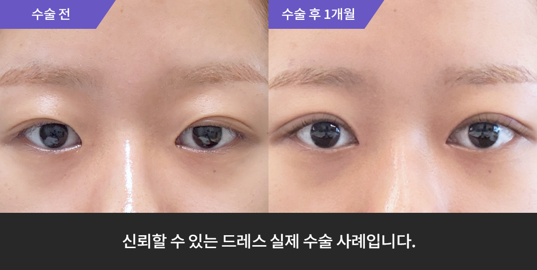 Before & After 2