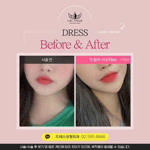 턱필러+자갈턱btx