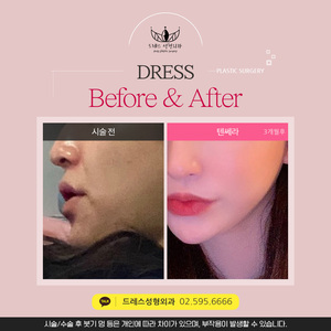 텐세라