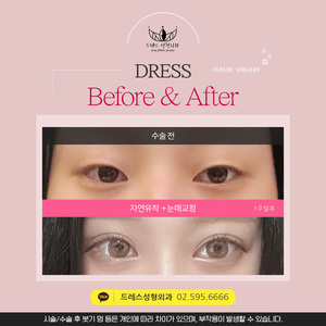 자연유착 + 눈매교정