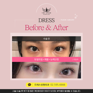 듀얼트임+매몰+눈매교정