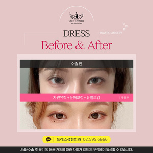 자연유착+눈매교정+듀얼트임
