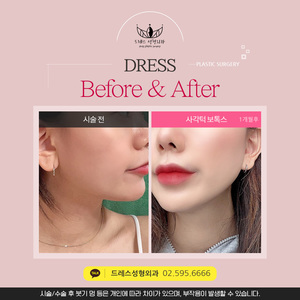 사각턱보톡스