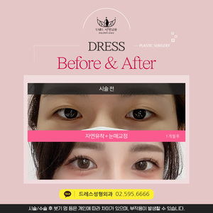 자연유착+눈매교정