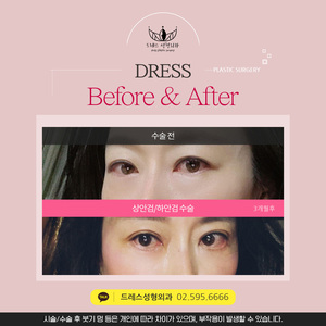 상안검+하안검