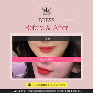 입술전체필러
