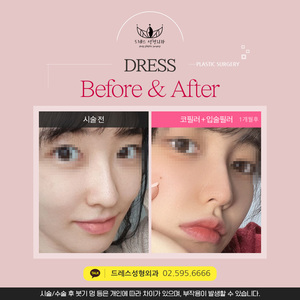 코필로 + 입술필러