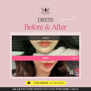 턱필러