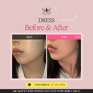 텐세라