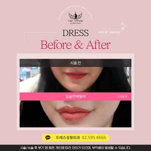 입술전체필러