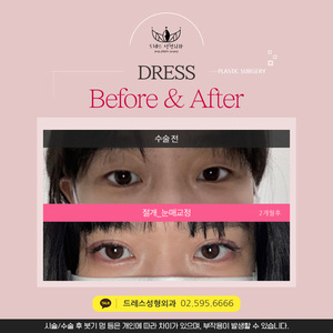절개눈매교정