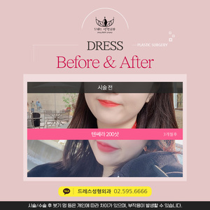 텐세라 200샷
