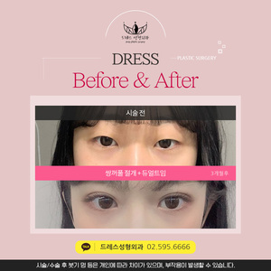 쌍꺼풀 절개+듀얼트임