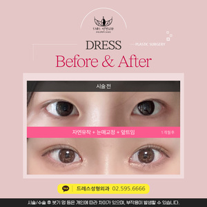 자연유착+눈매교정+앞트임