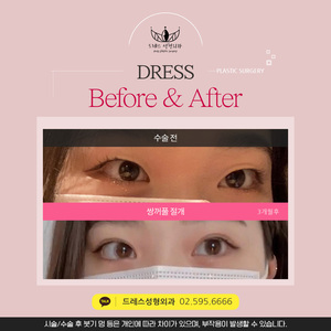 절개쌍꺼풀