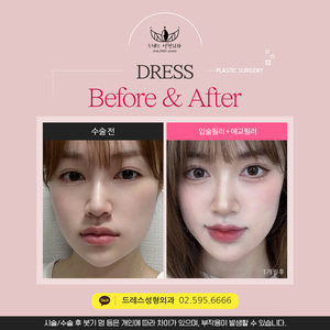 입술필러 + 애교필러