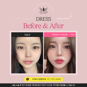 자연유착 + 눈매교정