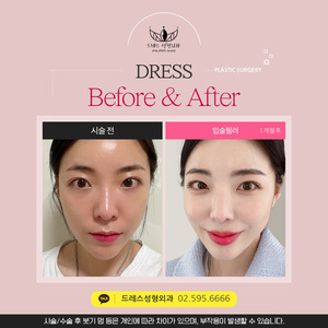 입술필러