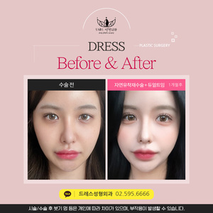 자연유착재수술 + 듀얼트임