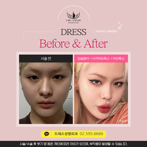 입술필러 + 사각턱보톡스 +  라인톡스