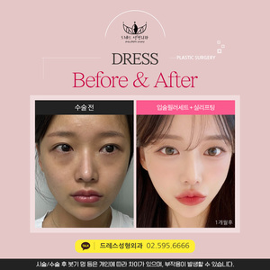 입술필러세트 + 실리프팅