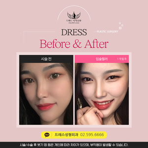입술필러