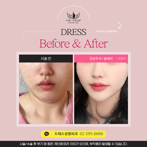 암살주사 + 울쎄라