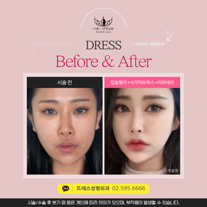 입술필러 + 사각턱보톡스 +_리프테라