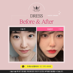 입술필러