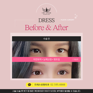 자연유착 + 눈매교정 + 윗트임
