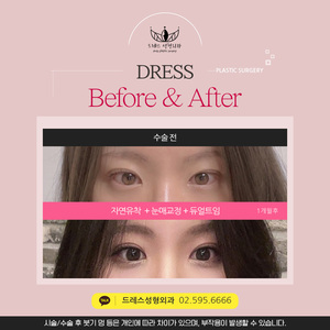 자연유착 + 눈매교정 + 듀얼트임