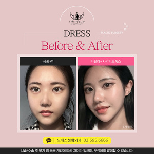 턱필러 + 사각턱보톡스