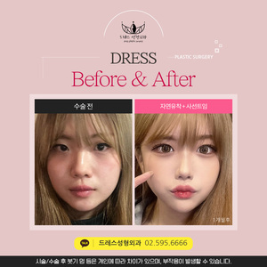 자연유착 + 사선트임