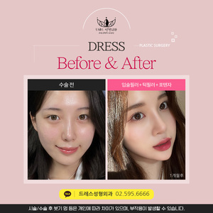 입술필러 + 턱필러 + 포텐자