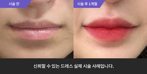 입술필러