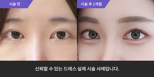 애교필러