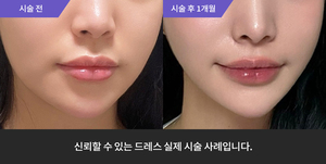 암살주사