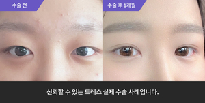 자연유착 + 눈매교정 + 윗트임