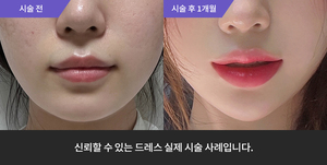 입술필러 + 포텐자 + 턱필러