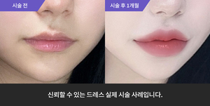 입술필러