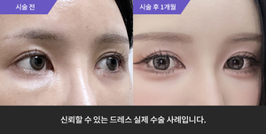 애교필러