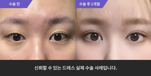 자연유착 재수술 + 눈매교정 재수술