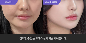 울쎄라 + 하이코 + 코필러