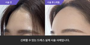 이마필러