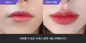 입술필러