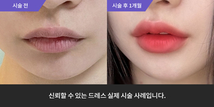 입술필러