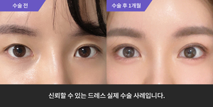 자연유착 + 눈매교정 +윗트임