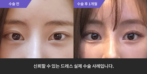 자연유착 재수술 + 윗트임