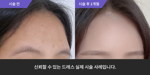 이마필러