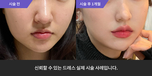리프테라